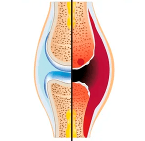 Η δομή μιας υγιούς και φθαρμένης άρθρωσης που ονομάζεται ιστός χόνδρου και αρθρικό υγρό