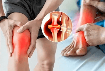 Σχέδιο εφαρμογής Icexin gel στην περιοχή της άρθρωσης του γόνατος και του ποδιού